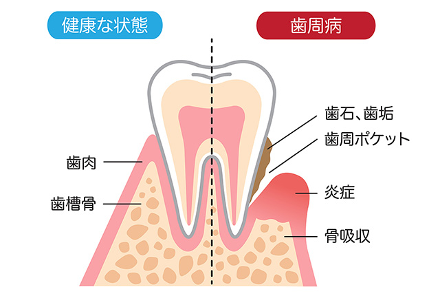 歯周病治療